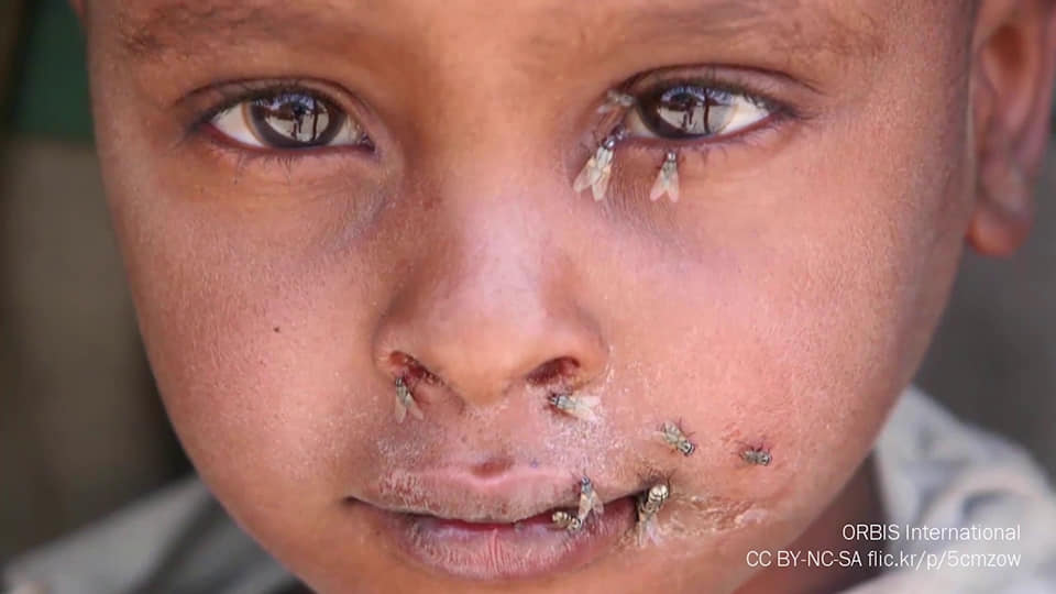 Une des maladies: le Trachome.